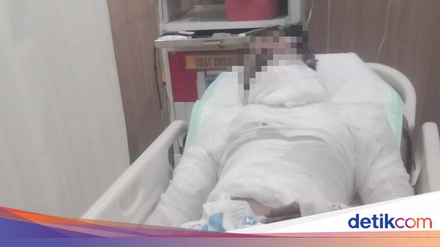 Sopir di Bali Dibakar Bos, Luka Parah dan Tak Bisa Bayar Perawatan